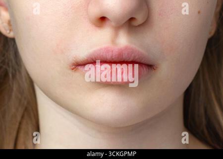 Nahaufnahme trockener und rissiger Lippen mit sichtbarer Reizung. Eine Nahaufnahme der Lippen einer Person, die Trockenheit, Risse und sichtbare Irritationen am zeigt Stockfoto