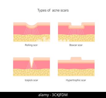 Set von Aknennarbenarten, atrophisch und hypertrophisch, rollend, Boxcar, Eispickel. Medizinische geometrische flache Illustration. Stock Vektor