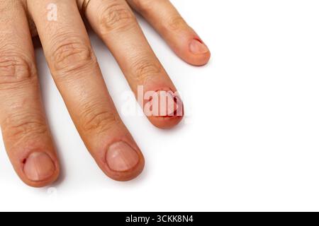 Maniküre selbst geschaffener Unfall mit Blutwunden in der Nähe des Nagels, Selbstpflegekonzept, Nahaufnahme auf weiß Stockfoto