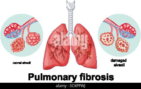 Vektor-Illustration zeigt gesunde versus beschädigte Alveolen in der Lunge und hebt die Auswirkungen der Lungenfibrose hervor Stock Vektor