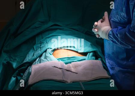 Sectio caesarea. Chirurgen, die Kaiserschnitt im Operationssaal durchführen. Stockfoto