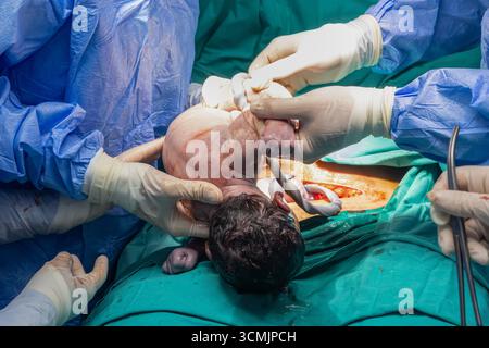 Geburt durch Kaiserschnitt im OP. Neugeborenes im Krankenhaus, OP-Tisch. Neues Leben, das Baby wird über die Kaiserabteilung in der Operationsabteilung geboren Stockfoto