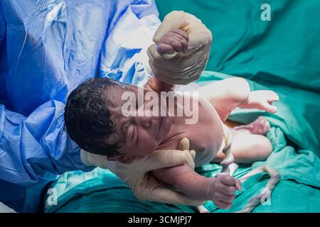 Geburt durch Kaiserschnitt im OP. Neugeborenes im Krankenhaus, OP-Tisch. Neues Leben, das Baby wird über die Kaiserabteilung in der Operationsabteilung geboren Stockfoto