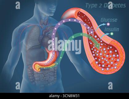 Abbildung einer menschlichen Figur auf blauem Hintergrund, die eine Arterie und den Blutkreislauf zeigt. Bei Typ-2-Diabetes werden die Zellen resistent gegen Insulin, was eine effiziente Glukoseverwendung verhindert. Obwohl die Bauchspeicheldrüse Insulin produziert, reicht diese nicht aus, um zu kompensieren und eine progressive Hyperglykämie zu verursachen. Stockfoto