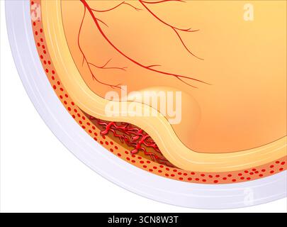 Abbildung einer altersbedingten Makuladegeneration (AMD), die zeigt, wie sich die Erkrankung auf die Makula auswirkt, den zentralen Teil der Netzhaut, der für das detaillierte Sehen verantwortlich ist. Im Laufe der Zeit kann das Altern die Zellen der Makula schädigen, was zu verschwommenem Sehen oder Verlust des zentralen Sehvermögens führen kann. Stockfoto
