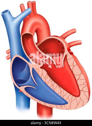 Illustration einer Aortenklappeninsuffizienz, einer Herzerkrankung, bei der die Aortenklappe nicht richtig schließt, sodass das Blut von der Aorta zurück in den linken Ventrikel fließen kann. Dies belastet das Herz zusätzlich und kann zu Symptomen wie Müdigkeit und Kurzatmigkeit führen. Stockfoto