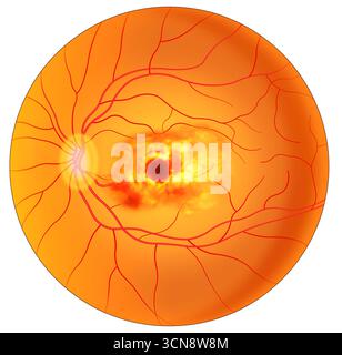 Illustration der Makuladegeneration, einer altersbedingten Augenkrankheit. Diese Augenerkrankung zerstört langsam das zentrale Sehen, den Teil des Auges, der das scharfe Vorwärtssehen steuert, und macht es schwierig, feine Details zu lesen und zu sehen. Diese Krankheit tritt am häufigsten bei Menschen über 60 Jahren auf. Stockfoto