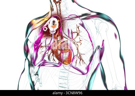 Hohlraumtuberkulose im Oberlappen der rechten Lunge. Abbildung: Lungenschäden und Hohlräume. Stockfoto