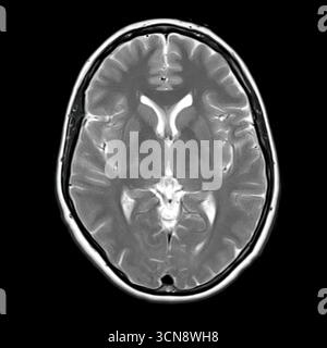 Magnetresonanztomographie (MRT) des menschlichen Gehirns mit normaler Anatomie der lateralen Ventrikel, des Thalamus und der Basalganglien ohne sichtbare Pathologie. Stockfoto