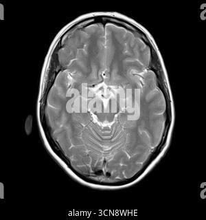 Magnetresonanztomographie (MRT) des menschlichen Gehirns mit mittleren und oberen Pons, Teilen des Hirnstamms, die an der motorischen Steuerung, den sensorischen Bahnen und den autonomen Funktionen beteiligt sind. Stockfoto