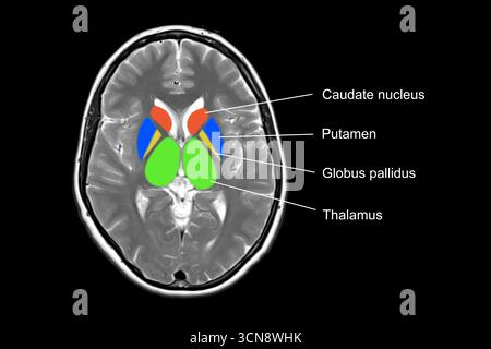 Magnetresonanztomographie (MRT) mit normaler Hirnanatomie mit markierten Basalganglien und Thalami. Stockfoto