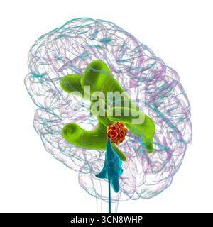 Illustration des vergrößerten lateralen und dritten Ventrikels des Gehirns (Hydrozephalus), hervorgerufen durch einen Hirntumor, der den Aquädukt des Gehirns komprimiert. Stockfoto