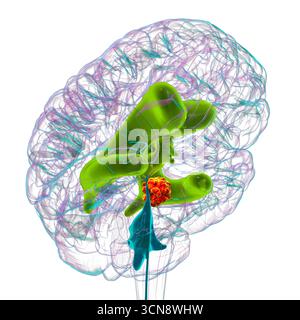 Darstellung der vergrößerten lateralen und dritten Ventrikel des Gehirns (Hydrozephalus), hervorgerufen durch einen Hirntumor, der den Aquädukt des Gehirns komprimiert. Stockfoto
