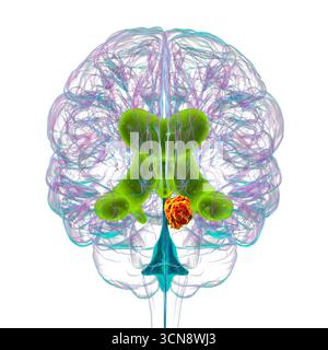 Darstellung der vergrößerten lateralen und dritten Ventrikel des Gehirns (Hydrozephalus), hervorgerufen durch einen Hirntumor, der den Aquädukt des Gehirns komprimiert. Stockfoto