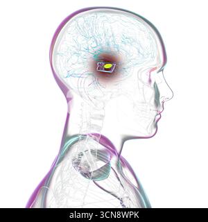 Illustration eines menschlichen Gehirns mit degenerierter Substantia nigra bei Morbus Parkinson, der Verlust pigmentierter Nervenzellen im Mittelhirn im Zusammenhang mit motorischer Dysfunktion zeigt. Stockfoto