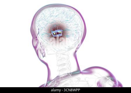 Illustration eines menschlichen Gehirns mit degenerierter Substantia nigra bei Morbus Parkinson, der Verlust pigmentierter Nervenzellen im Mittelhirn im Zusammenhang mit motorischer Dysfunktion zeigt. Stockfoto