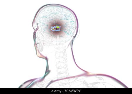 Illustration eines menschlichen Gehirns mit degenerierter Substantia nigra bei Morbus Parkinson, der Verlust pigmentierter Nervenzellen im Mittelhirn im Zusammenhang mit motorischer Dysfunktion zeigt. Stockfoto