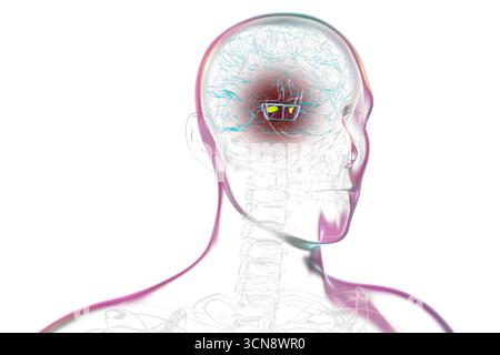 Illustration eines menschlichen Gehirns mit degenerierter Substantia nigra bei Morbus Parkinson, der Verlust pigmentierter Nervenzellen im Mittelhirn im Zusammenhang mit motorischer Dysfunktion zeigt. Stockfoto