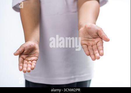 Hand-, Maul- und Klauenseuche HFMD menschliche Hand des Scharlachfiebers beim Coxsackievirus palmarosa Virus und Kinderhand auf weißem Hintergrund Stockfoto