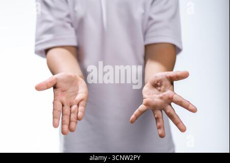 Hand-, Maul- und Klauenseuche HFMD menschliche Hand des Scharlachfiebers beim Coxsackievirus palmarosa Virus und Kinderhand auf weißem Hintergrund Stockfoto