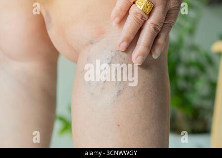 Konzept Hautgesundheit. Nahaufnahme von Krampfadern an den Beinen der Seniorin, Beine der Alten Frau mit Krampfadern zu Hause. Stockfoto