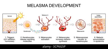 Die Melasmaentwicklung. Sichtbare Pigmentierung in der menschlichen Haut. Chloasma faciei. Schwangerschaftsmaske. Melaninakkumulation in der Epidermis. Nahaufnahme der Melanozyten Stock Vektor