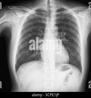 Thoraxröntgenaufnahme mit Lunge, Wirbelsäule und Rippen mit medizinischen Bildgebungsdetails. Schultergelenk, Sehnen- und Knochenverletzungen. Gesundheitsfilmkonzept Stockfoto