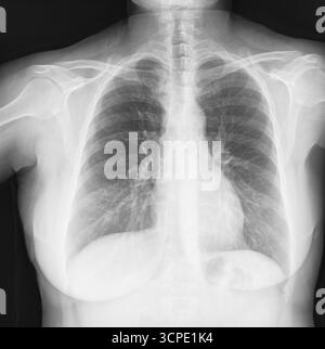 Thoraxröntgenaufnahme mit Lunge, Wirbelsäule und Rippen mit medizinischen Bildgebungsdetails. Schultergelenk, Sehnen- und Knochenverletzungen. Gesundheitsfilmkonzept Stockfoto