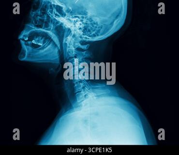 Laterale Röntgenaufnahme des menschlichen Halses und der Halswirbelsäule auf schwarzem Hintergrund. Bild der medizinischen Diagnostik. Wirbel, Schädelbasis und Atemwege Stockfoto