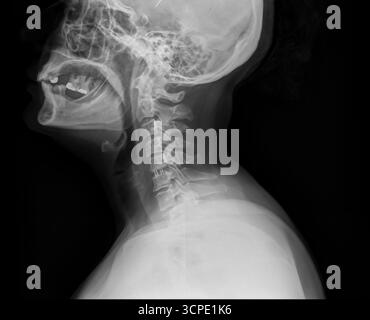 Laterale Röntgenaufnahme des menschlichen Halses und der Halswirbelsäule auf schwarzem Hintergrund. Bild der medizinischen Diagnostik. Wirbel, Schädelbasis und Atemwege Stockfoto