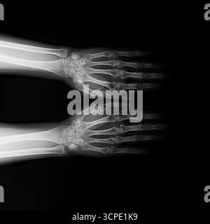 Symmetrische Röntgenaufnahme zweier menschlicher Handgelenke und Hände mit Unterarmen auf schwarzem Hintergrund. Medizinisches Bild mit Knochen Stockfoto