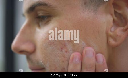 Junger Mann, der Akne kontrollierende Gesichtswäsche für Männer anwendet, um Hautausbrüche und Aknenarben zu stoppen, Seitenansicht Nahaufnahme. Hautproblem- und Störungskonzepte. Stockfoto