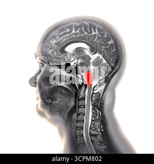 Abbildung einer farbigen Magnetresonanztomographie (MRT) der im menschlichen Gehirn hervorgehobenen Medulla oblongata. Das steuert die Atmung, den Herzen Stockfoto