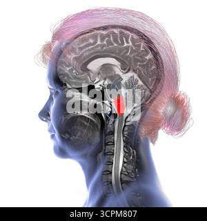 Abbildung einer farbigen Magnetresonanztomographie (MRT) der im menschlichen Gehirn hervorgehobenen Medulla oblongata. Das steuert die Atmung, den Herzen Stockfoto