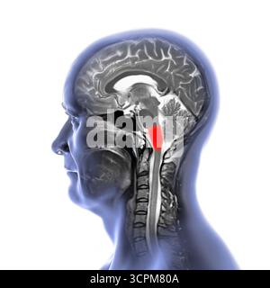 Abbildung einer farbigen Magnetresonanztomographie (MRT) der im menschlichen Gehirn hervorgehobenen Medulla oblongata. Das steuert die Atmung, den Herzen Stockfoto