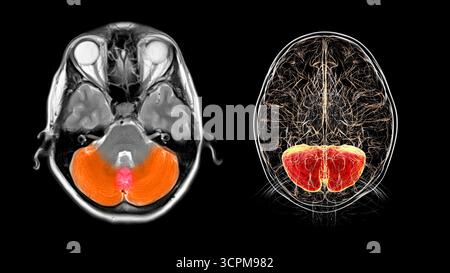 Magnetresonanztomographie (MRT) und Darstellung des Kleinhirns (links) und der Hirnanatomie mit hervorgehobenem Kleinhirn (rechts). Es ist unpraktisch Stockfoto