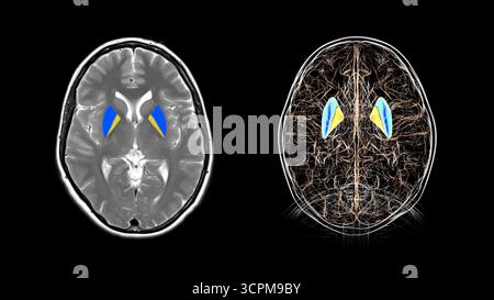 Abbildung und farbige Magnetresonanztomographie (MRT) des menschlichen Gehirns mit hervorgehobenen Putamen (blau) und Globus pallidus (gelb), Taste b Stockfoto