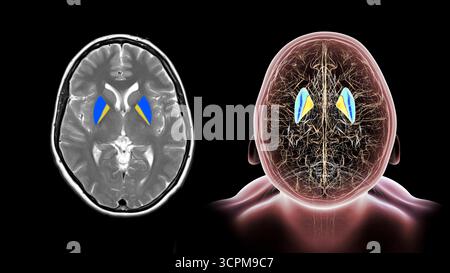 Abbildung und farbige Magnetresonanztomographie (MRT) des menschlichen Gehirns mit hervorgehobenen Putamen (blau) und Globus pallidus (gelb), Taste b Stockfoto