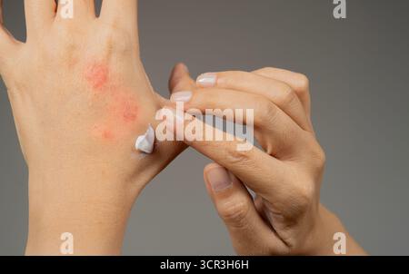 Zugeschnittene Aufnahme Ansicht der Frau, die Feuchtigkeitscreme auf ihrer Hand für trockene schuppige Haut aufträgt, wie bei der Behandlung von Psoriasis, Ekzemen und anderen Erkrankungen von d Stockfoto