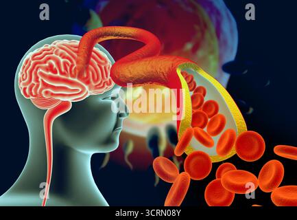 Cholesterinplaque in Arterien mit menschlicher Hirnanatomie. 3D-Abbildung Stockfoto
