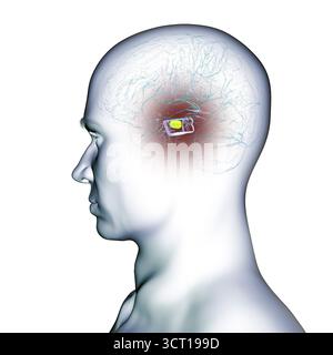 Illustration eines menschlichen Gehirns mit degenerierter Substantia nigra bei Morbus Parkinson, der Verlust pigmentierter Nervenzellen im Mittelhirn im Zusammenhang mit motorischer Dysfunktion zeigt. Stockfoto