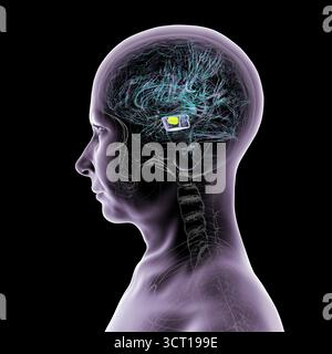 Illustration eines menschlichen Gehirns mit degenerierter Substantia nigra bei Morbus Parkinson, der Verlust pigmentierter Nervenzellen im Mittelhirn im Zusammenhang mit motorischer Dysfunktion zeigt. Stockfoto