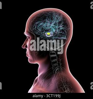 Illustration eines menschlichen Gehirns mit degenerierter Substantia nigra bei Morbus Parkinson, der Verlust pigmentierter Nervenzellen im Mittelhirn im Zusammenhang mit motorischer Dysfunktion zeigt. Stockfoto
