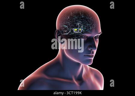 Illustration eines menschlichen Gehirns mit degenerierter Substantia nigra bei Morbus Parkinson, der Verlust pigmentierter Nervenzellen im Mittelhirn im Zusammenhang mit motorischer Dysfunktion zeigt. Stockfoto