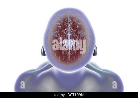 Illustration eines menschlichen Gehirns mit degenerierter Substantia nigra bei Morbus Parkinson, der Verlust pigmentierter Nervenzellen im Mittelhirn im Zusammenhang mit motorischer Dysfunktion zeigt. Stockfoto