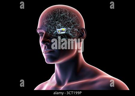 Illustration eines menschlichen Gehirns mit degenerierter Substantia nigra bei Morbus Parkinson, der Verlust pigmentierter Nervenzellen im Mittelhirn im Zusammenhang mit motorischer Dysfunktion zeigt. Stockfoto