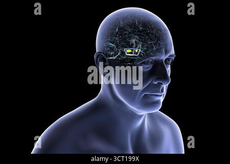 Illustration eines menschlichen Gehirns mit degenerierter Substantia nigra bei Morbus Parkinson, der Verlust pigmentierter Nervenzellen im Mittelhirn im Zusammenhang mit motorischer Dysfunktion zeigt. Stockfoto