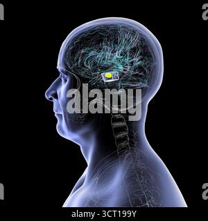 Illustration eines menschlichen Gehirns mit degenerierter Substantia nigra bei Morbus Parkinson, der Verlust pigmentierter Nervenzellen im Mittelhirn im Zusammenhang mit motorischer Dysfunktion zeigt. Stockfoto