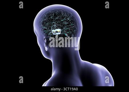 Illustration eines menschlichen Gehirns mit degenerierter Substantia nigra bei Morbus Parkinson, der Verlust pigmentierter Nervenzellen im Mittelhirn im Zusammenhang mit motorischer Dysfunktion zeigt. Stockfoto
