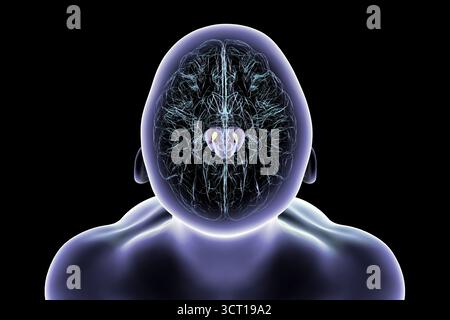 Illustration eines menschlichen Gehirns mit degenerierter Substantia nigra bei Morbus Parkinson, der Verlust pigmentierter Nervenzellen im Mittelhirn im Zusammenhang mit motorischer Dysfunktion zeigt. Stockfoto